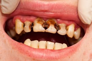 Tooth decay